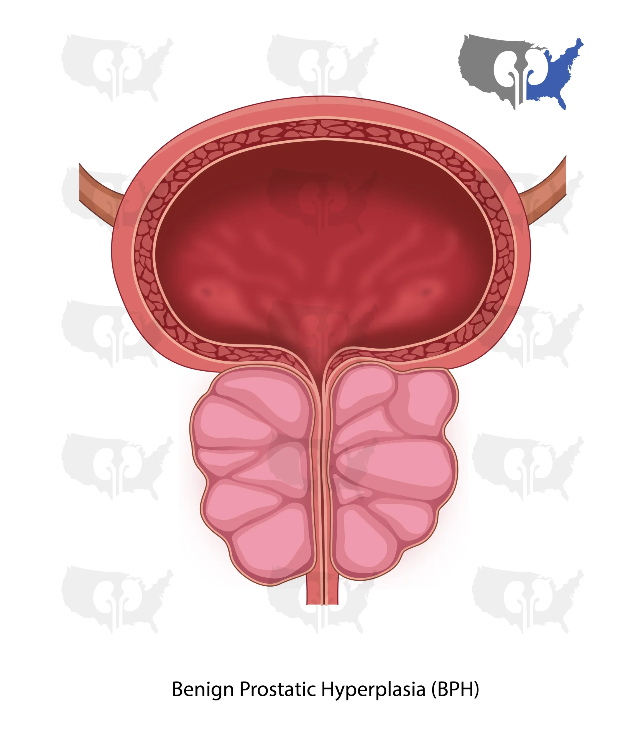 Benign Prostatic Hyperplasia